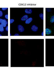 Ewing sarcoma